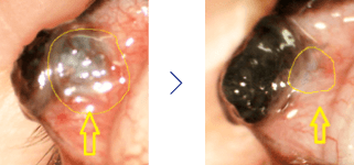 眼瞼に出来たマイボーム腺腫